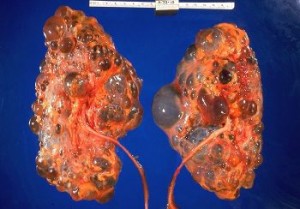 Cystic_kidneys