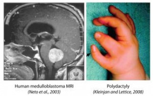 medulloblastoma tumor and child hand with polydactyly
